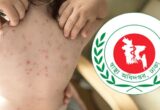 দেশে হামের উপসর্গে প্রাণ গেল আরও পাঁচ শিশুর