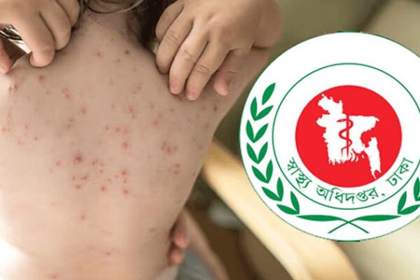দেশে হামের উপসর্গে প্রাণ গেল আরও পাঁচ শিশুর